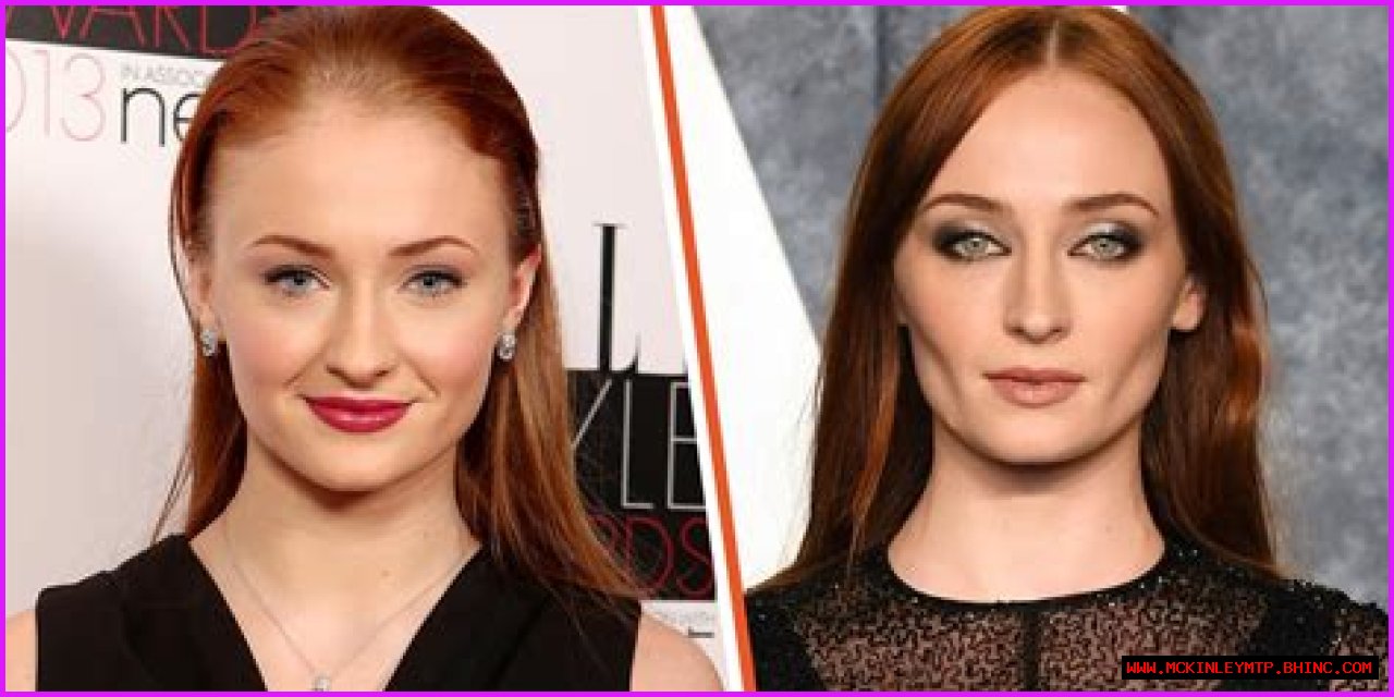 Unveiling The Transformation: Sophie Turner And Buccal Fat Removal